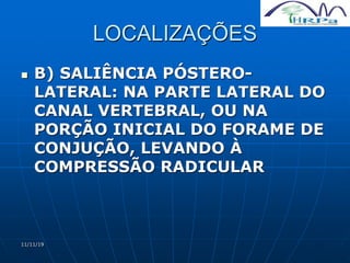 11/11/19
LOCALIZAÇÕES
 B) SALIÊNCIA PÓSTERO-
LATERAL: NA PARTE LATERAL DO
CANAL VERTEBRAL, OU NA
PORÇÃO INICIAL DO FORAME DE
CONJUÇÃO, LEVANDO À
COMPRESSÃO RADICULAR
 