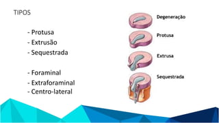 TIPOS
- Protusa
- Extrusão
- Sequestrada
- Foraminal
- Extraforaminal
- Centro-lateral
 