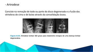 - Artrodese
Consiste na remoção de todo ou parte do disco degenerado e a fusão das
vértebras de cima e de baixo através da consolidação óssea.
 