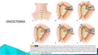 - DISCECTOMIA
 