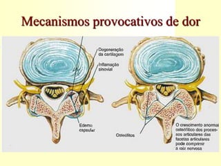 Mecanismos provocativos de dor
 