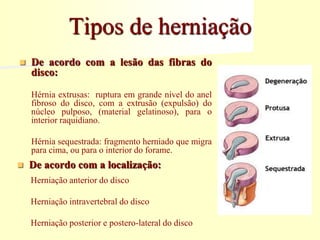 Tipos de herniação
 De acordo com a lesão das fibras do
disco:
Hérnia extrusas: ruptura em grande nível do anel
fibroso do disco, com a extrusão (expulsão) do
núcleo pulposo, (material gelatinoso), para o
interior raquidiano.
Hérnia sequestrada: fragmento herniado que migra
para cima, ou para o interior do forame.
 De acordo com a localização:
Herniação anterior do disco
Herniação intravertebral do disco
Herniação posterior e postero-lateral do disco
 