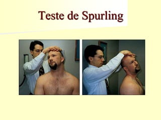 Teste de Spurling
 