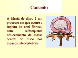 Conceito
A hérnia de disco é um
processo em que ocorre a
ruptura do anel fibroso,
com subsequente
deslocamento da massa
central do disco nos
espaços intervertebrais.
 