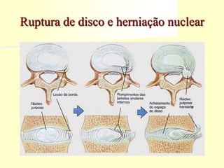 Ruptura de disco e herniação nuclear
 