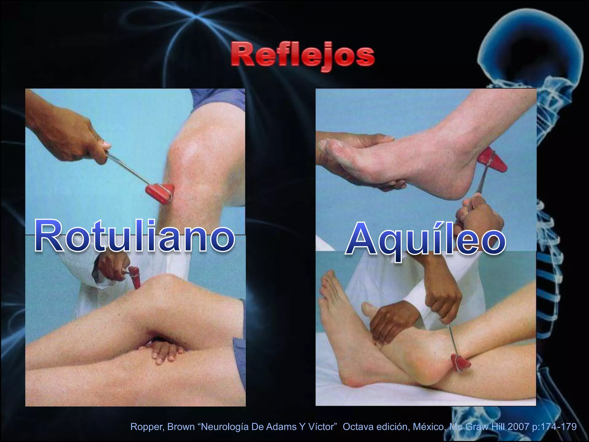 Hernia de L2-L3Afección de N. L3Ropper, Brown “Neurología De Adams Y Víctor”  Octava edición, México, Mc Graw Hill 2007 p:174-179