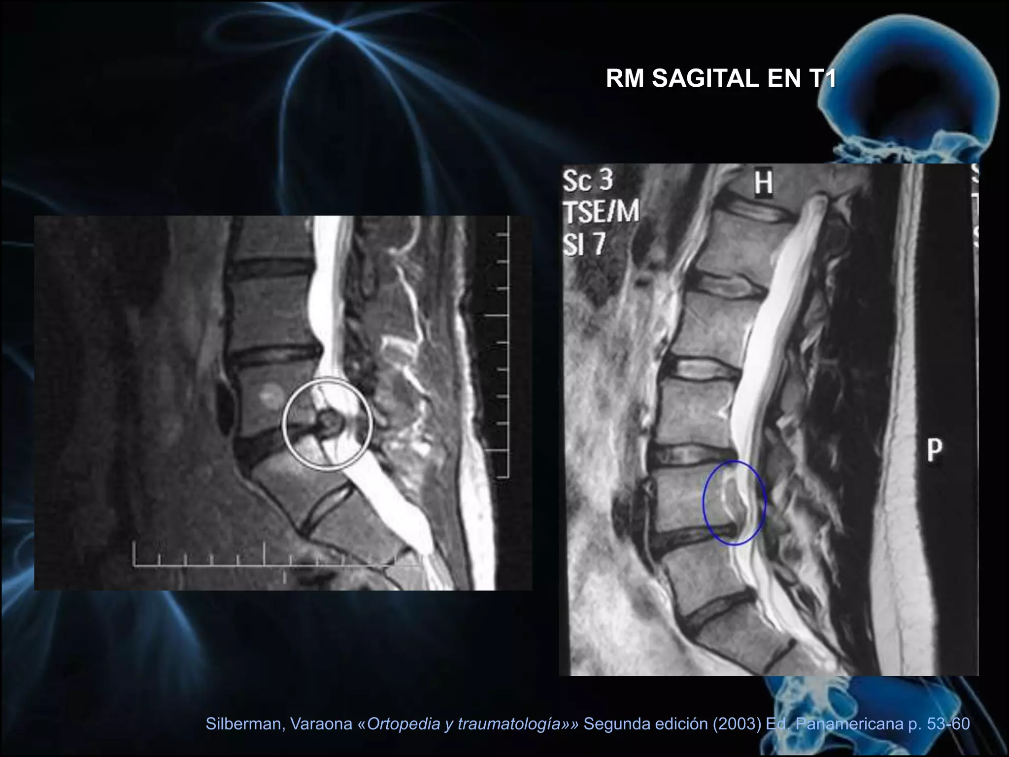 Hernia de L5-S1Afección de N. S1Ropper, Brown “Neurología De Adams Y Víctor”  Octava edición, México, Mc Graw Hill 2007 p:174-179