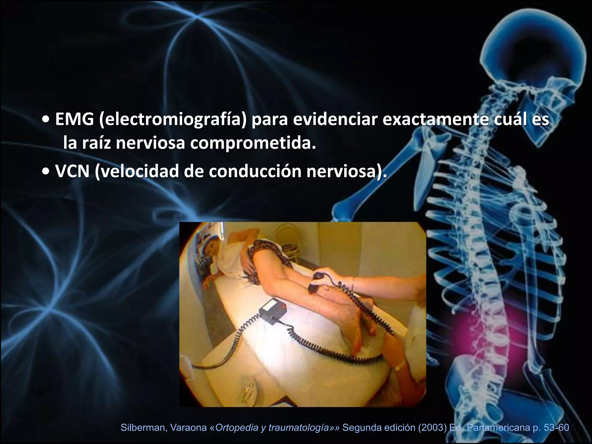 Signo LasègueLasègue invertido o Wasserman