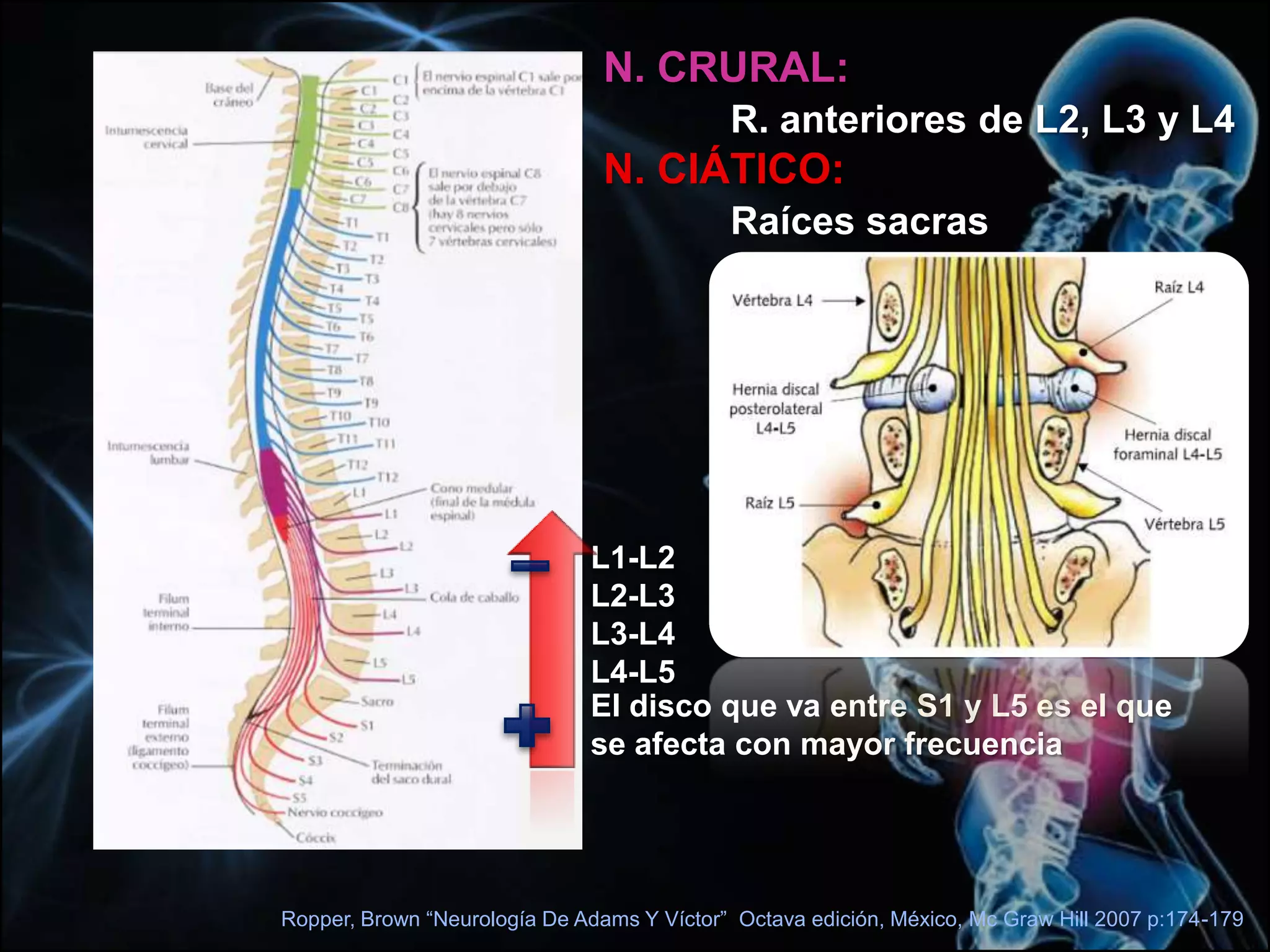 Ropper, Brown “Neurología De Adams Y Víctor”  Octava edición, México, Mc Graw Hill 2007 p:174-179N. CRURAL: R. anteriores de L2, L3 y L4N. CIÁTICO: Raíces sacrasL1-L2L2-L3L3-L4L4-L5El disco que va entre S1 y L5 es el que se afecta con mayor frecuencia