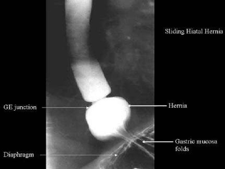 Hernia de hiato