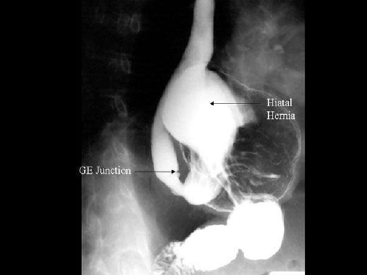 Hernia de hiato