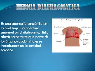 HERNIA DIAFRAGMATICA Es una anomalía congénita en la cual hay una abertura anormal en el diafragma,  Esta abertura permite que parte de los órganos abdominales se introduzcan en la cavidad torácica  
