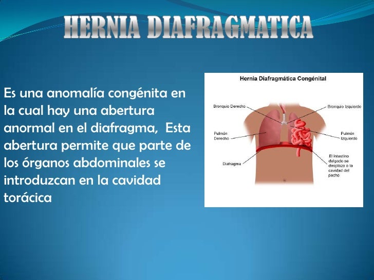 hernia-diafragm-tica-definici-n-causas-y-tipos-xvgxuz