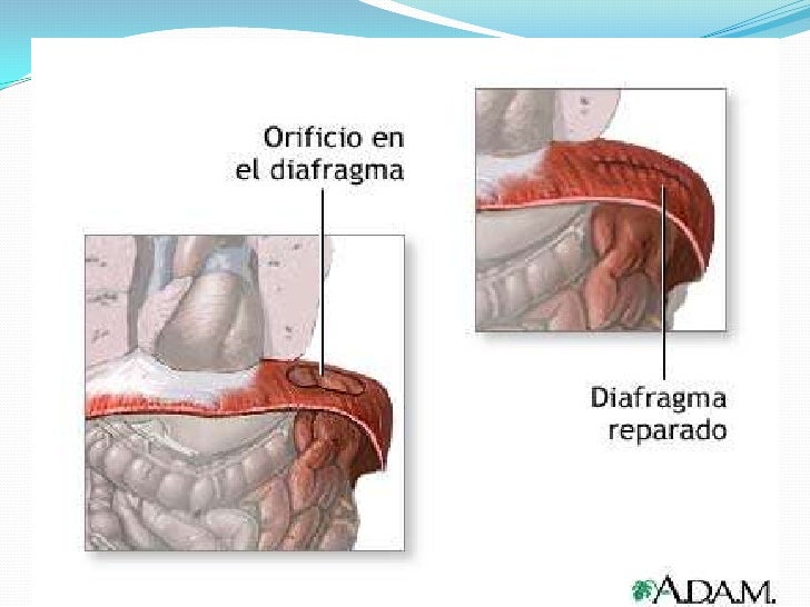 Hernia diafragmatica