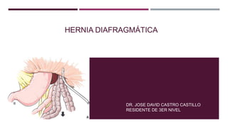 HERNIA DIAFRAGMÁTICA
DR. JOSE DAVID CASTRO CASTILLO
RESIDENTE DE 3ER NIVEL
 