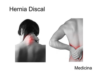Hernia Discal Medicina 