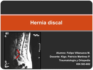 Hernia discal




            Alumno: Felipe Villanueva M.
       Docente: Klgo. Patricio Martínez P.
               Traumatología y Ortopedia
                             KIN 503-602
 
