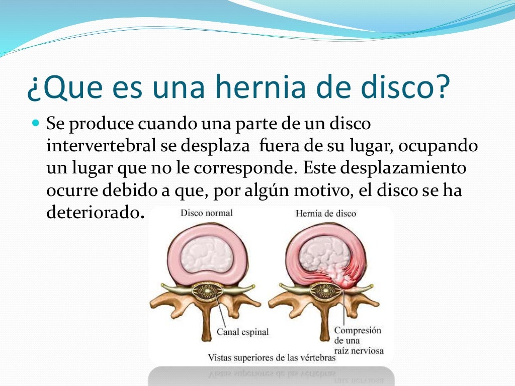Hernia discal lumbar diego gualotuña