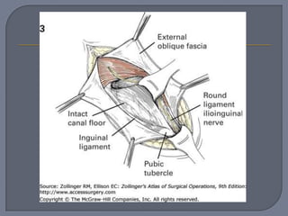 Hernia femoral