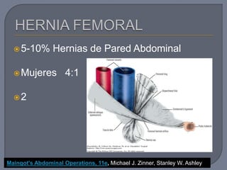 5-10% Hernias de Pared Abdominal
Mujeres 4:1
2
Maingot's Abdominal Operations, 11e, Michael J. Zinner, Stanley W. Ashley