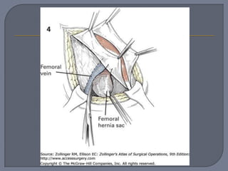 Hernia femoral