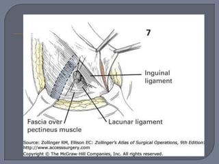 Hernia femoral