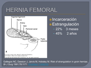 Incarceración
Estrangulación
• 22% 3 meses
• 45% 2 años
Gallegos NC, Dawson J, Jarvis M, Hobsley M. Risk of strangulation in groin hernias.
Br J Surg 1991;78:1171 [PubMed: 1958976]
 