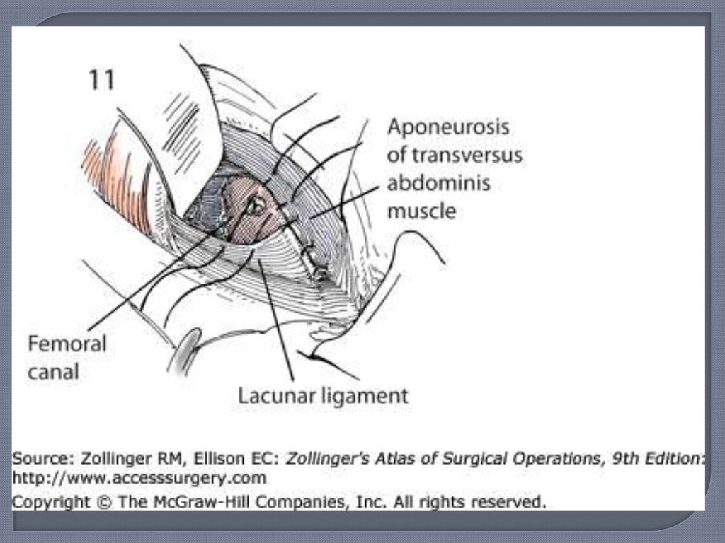 femoral-hernia