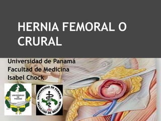 HERNIA FEMORAL O
CRURAL
Universidad de Panamá
Facultad de Medicina
Isabel Chock
 