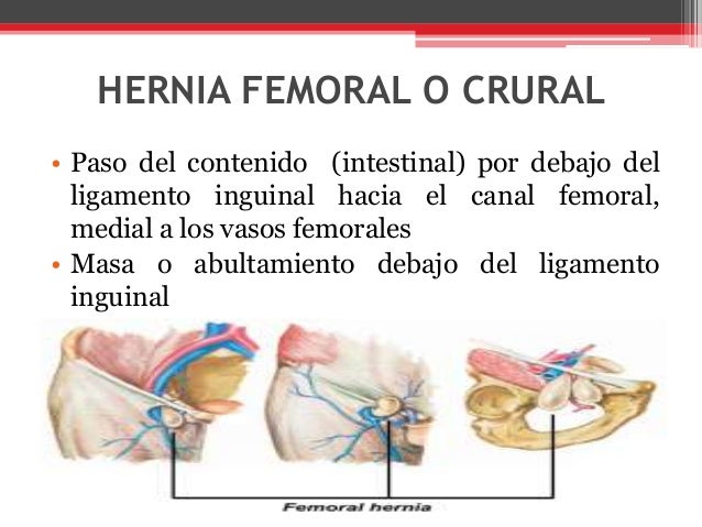 Hernia femoral o crural