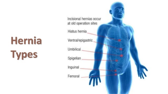 Hernia lower abdominal scrotum diagram 