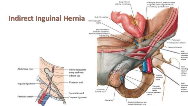 incarcerated hernia