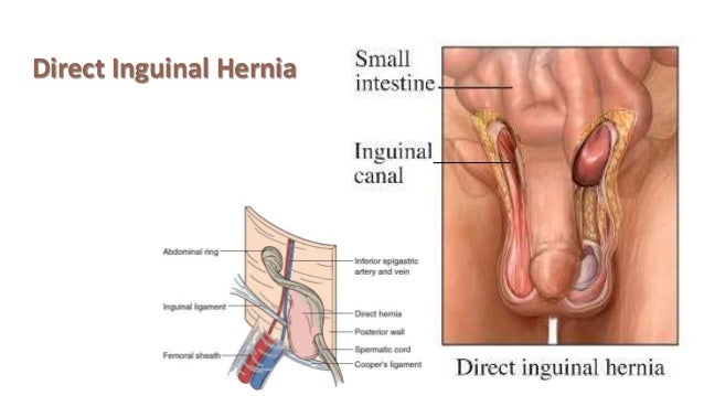 incarcerated hernia