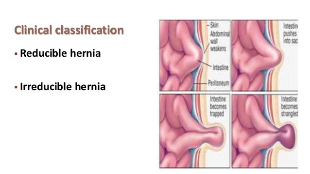 hernia how do hernias form