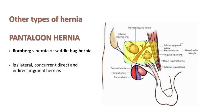 Hernia