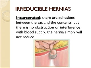 IRREDUCIBLE HERNIAS
IRREDUCIBLE HERNIAS
Incarcerated
Incarcerated: there are adhesions
between the sac and the contents, but
there is no obstruction or interference
with blood supply. the hernia simply will
not reduce
 
