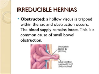 IRREDUCIBLE HERNIAS
IRREDUCIBLE HERNIAS
 Obstructed
Obstructed: a hollow viscus is trapped
within the sac and obstruction occurs.
The blood supply remains intact. This is a
common cause of small bowel
obstruction.
 