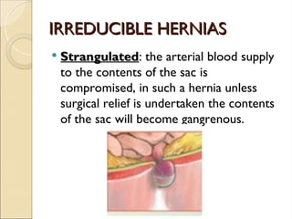IRREDUCIBLE HERNIAS
IRREDUCIBLE HERNIAS
 Strangulated
Strangulated: the arterial blood supply
to the contents of the sac is
compromised, in such a hernia unless
surgical relief is undertaken the contents
of the sac will become gangrenous.
 