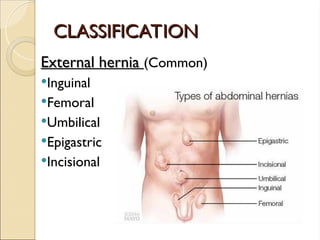 CLASSIFICATION
CLASSIFICATION
External hernia
External hernia (Common)
Inguinal
Femoral
Umbilical
Epigastric
Incisional
 