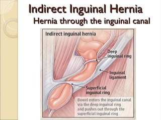 Indirect Inguinal Hernia
Indirect Inguinal Hernia
Hernia through the inguinal canal
Hernia through the inguinal canal
 