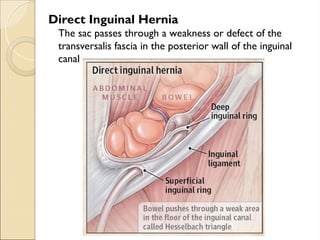 Direct Inguinal Hernia
The sac passes through a weakness or defect of the
transversalis fascia in the posterior wall of the inguinal
canal
 