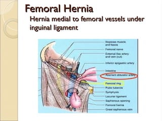 Femoral Hernia
Femoral Hernia
Hernia medial to femoral vessels under
Hernia medial to femoral vessels under
inguinal ligament
inguinal ligament
 