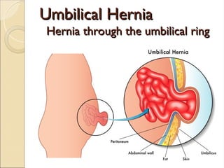 Umbilical Hernia
Umbilical Hernia
Hernia through the umbilical ring
Hernia through the umbilical ring
 