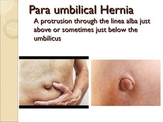 Para umbilical Hernia
Para umbilical Hernia
A protrusion through the linea alba just
A protrusion through the linea alba just
above or sometimes just below the
above or sometimes just below the
umbilicus
umbilicus
 