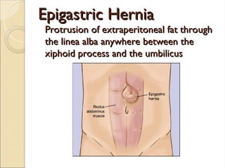 Epigastric Hernia
Epigastric Hernia
Protrusion of extraperitoneal fat through
Protrusion of extraperitoneal fat through
the linea alba anywhere between the
the linea alba anywhere between the
xiphoid process and the umbilicus
xiphoid process and the umbilicus
 