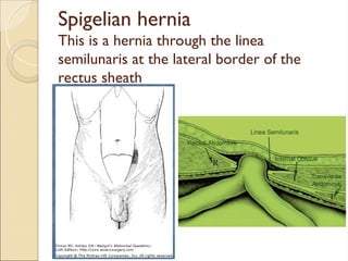 Spigelian hernia
This is a hernia through the linea
semilunaris at the lateral border of the
rectus sheath
 