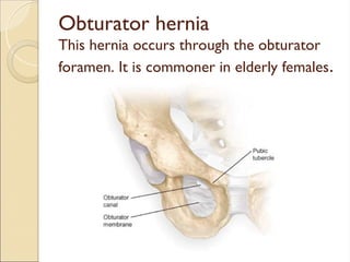 Obturator hernia
This hernia occurs through the obturator
foramen. It is commoner in elderly females.
 