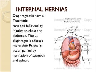 INTERNAL HERNIAS
INTERNAL HERNIAS
Diaphragmatic hernia
Traumatic:
rare and followed by
injuries to chest and
abdomen. The Lt
diaphragm is affected
more than Rt and is
accompanied by
herniation of stomach
and spleen.
 