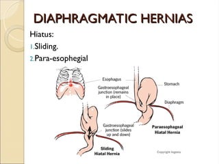 DIAPHRAGMATIC HERNIAS
DIAPHRAGMATIC HERNIAS
Hiatus:
1.Sliding.
2.Para-esophegial
 