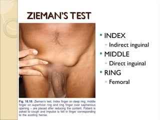 ZIEMAN’S TEST
ZIEMAN’S TEST
 INDEX
◦ Indirect inguinal
 MIDDLE
◦ Direct inguinal
 RING
◦ Femoral
 